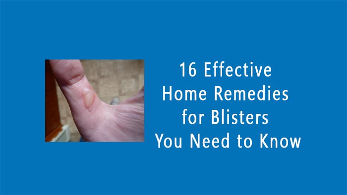 Home Remedies for Blisters