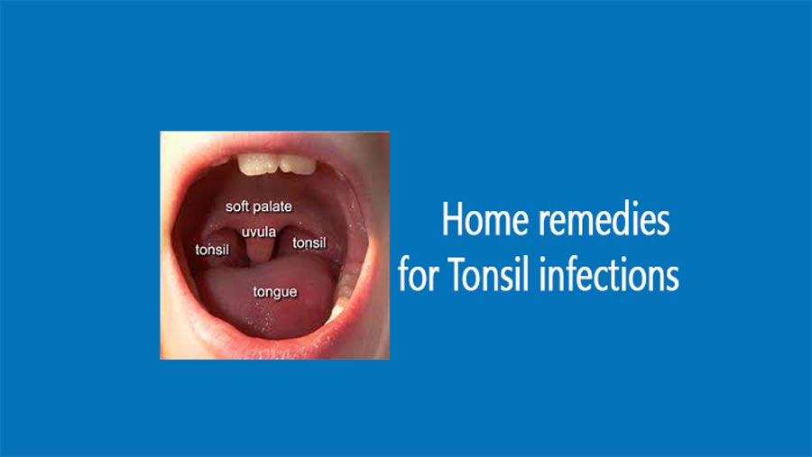 home remedies for tonsil