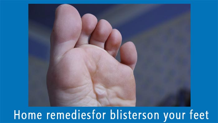 Home remedies for blisters
