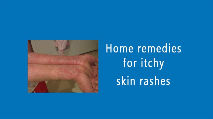 home remedies for itchy skin rashes
you should know more here