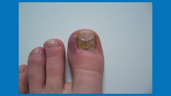 Fix an Ingrown Toenail
