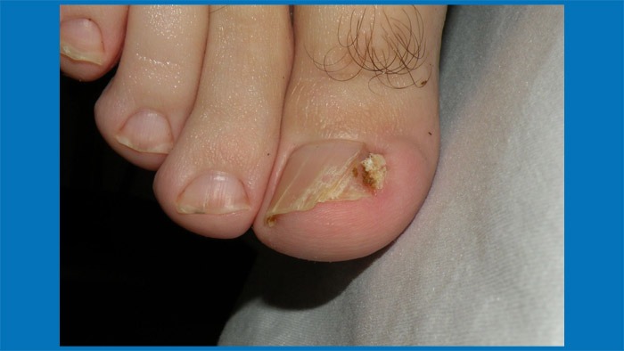 Fix an Ingrown Toenail